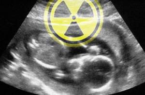 Радиация из ЧАЭС найдена в позвонках неродившихся детей